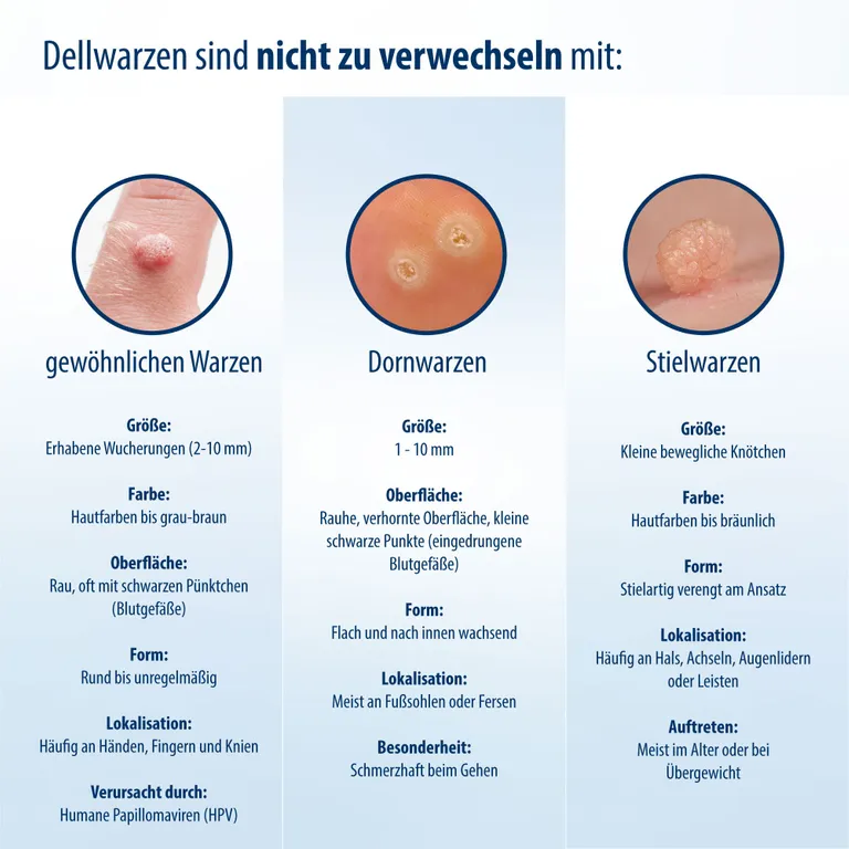 shopapotheke Evolsin® Dellwarzen Mittel I Für Erwachsene & Kinder ab 2 Jahren I Dellwarzen Behandlung mit Ätzkali Online